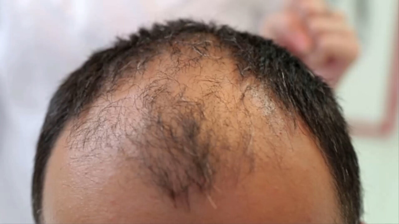 Balding and hair loss tied to air pollution in new study