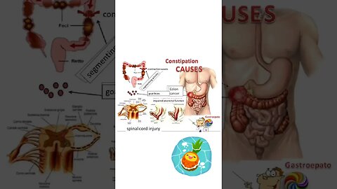 constipation or sembelit is .....