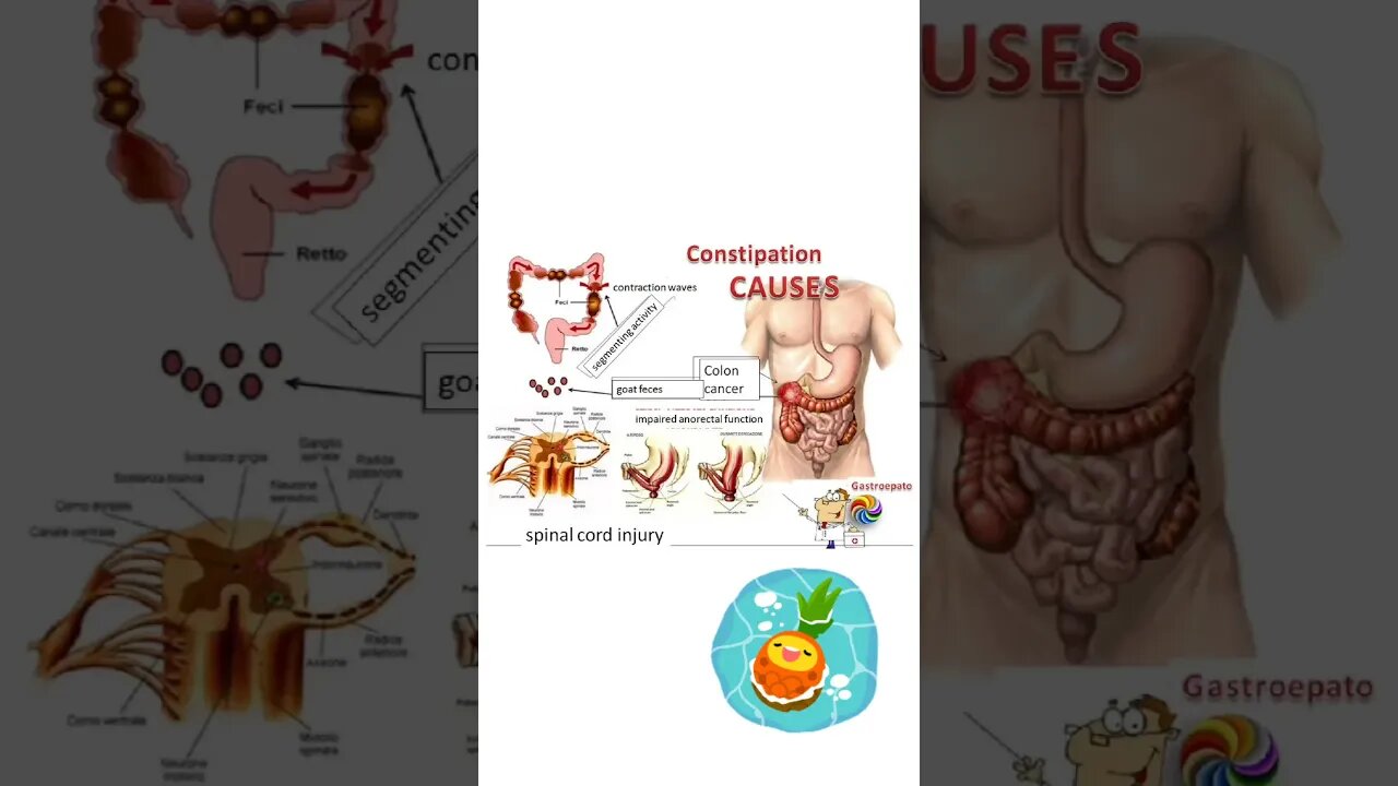 constipation or sembelit is .....