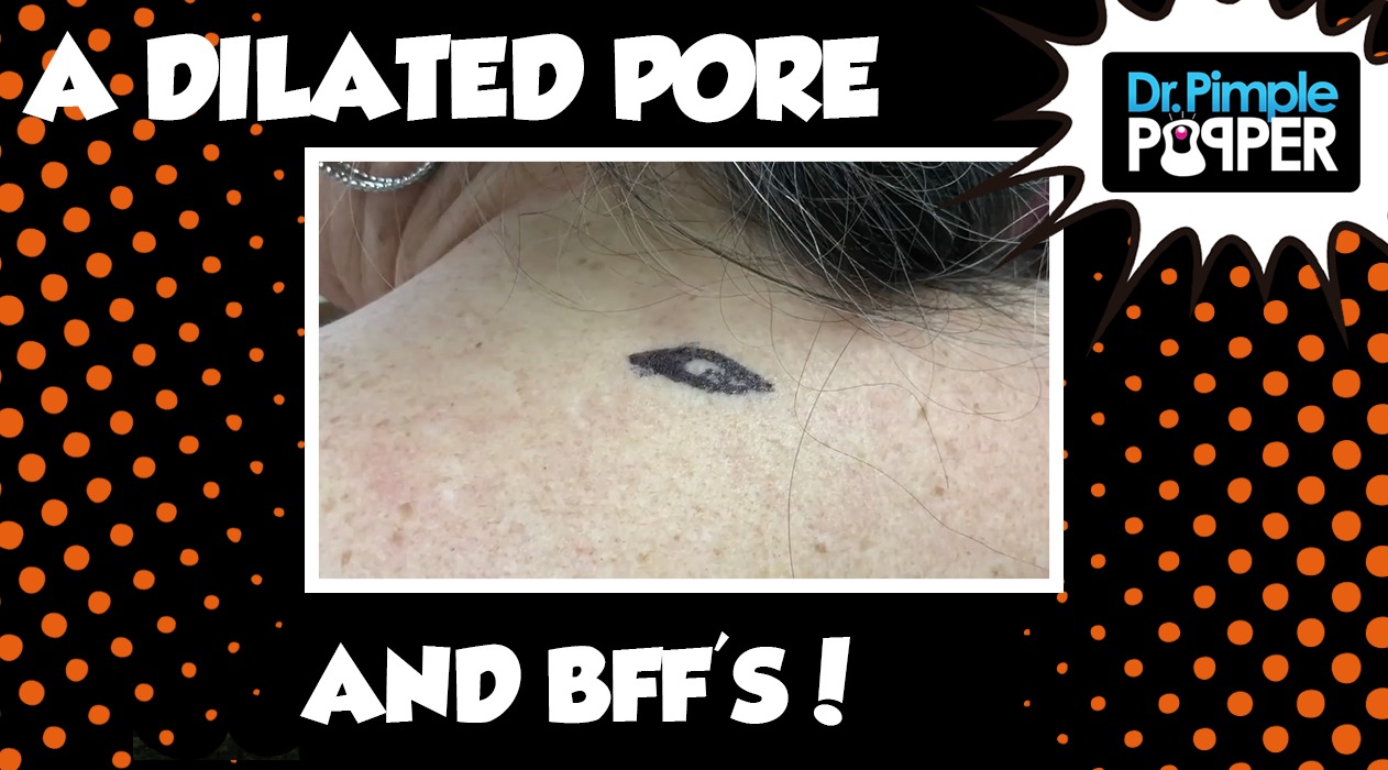 A Dilated Pore and BFF's!