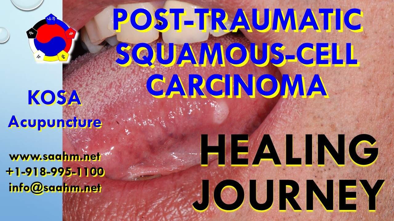 Post-Traumatic Squamous-Cell Carcinoma Testimonial