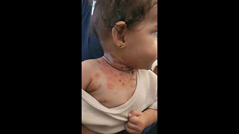 Gaza: manca l'acqua, manca tutto: le infezioni dilagano. Dio stramaledica israele.