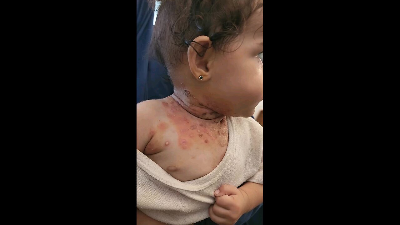 Gaza: manca l'acqua, manca tutto: le infezioni dilagano. Dio stramaledica israele.