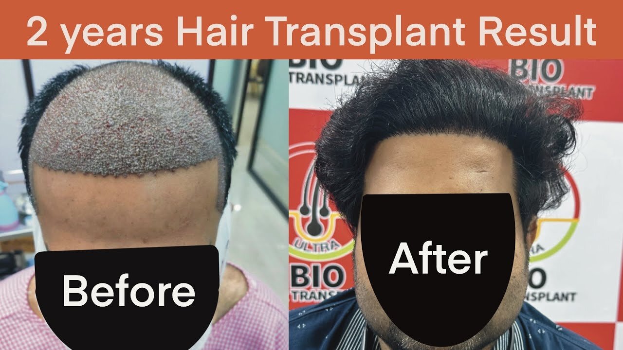 2 Year Hair Transplant Result