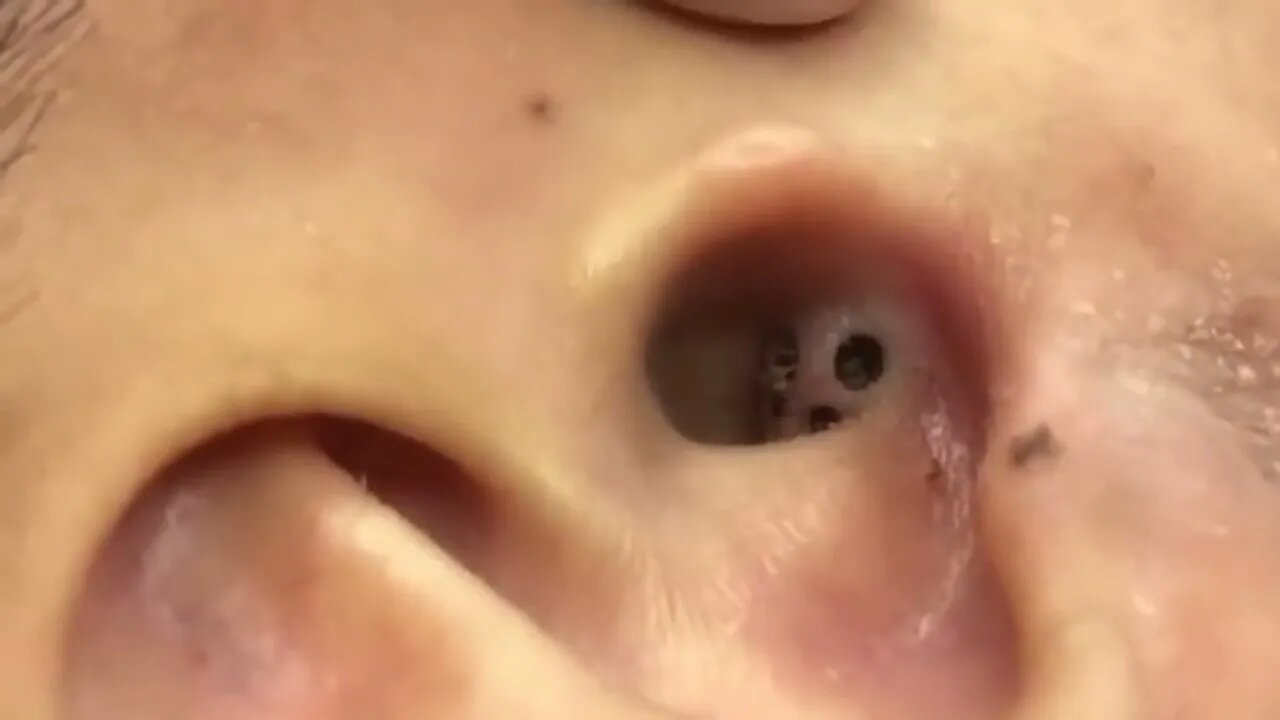 SnapSave io Retirando cravo gigante da orelha Acne, espinha, cravo, comedões, abscessos