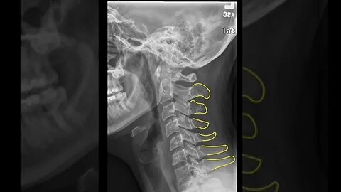 Cervical XRAY Short PartA #shorts