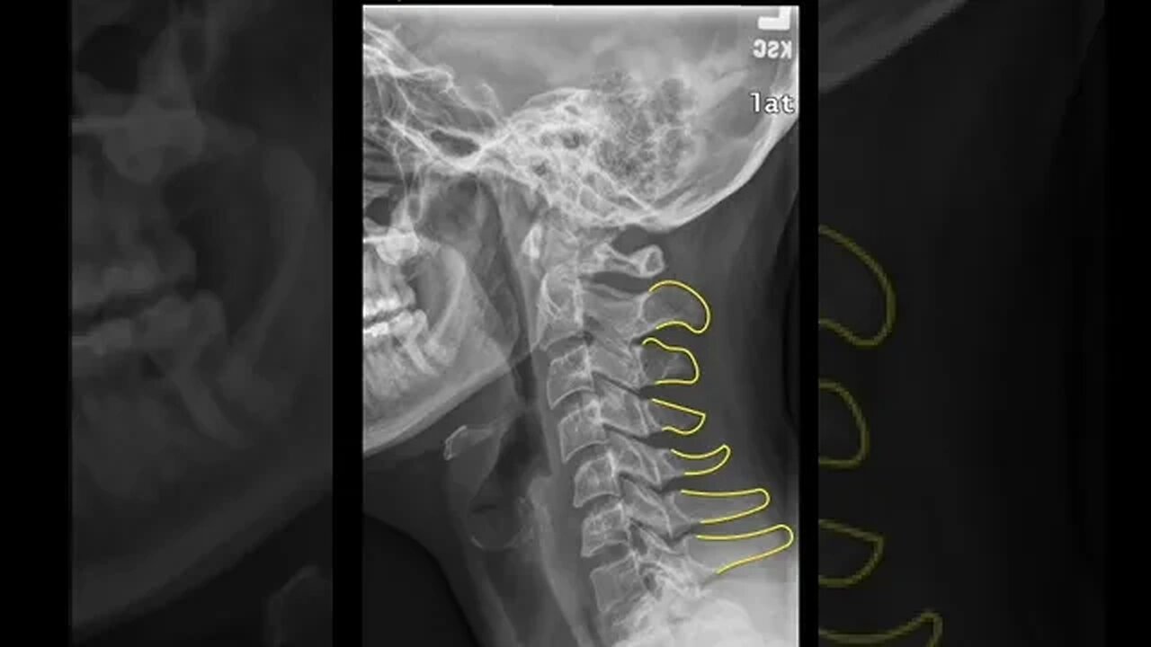 Cervical XRAY Short PartA #shorts