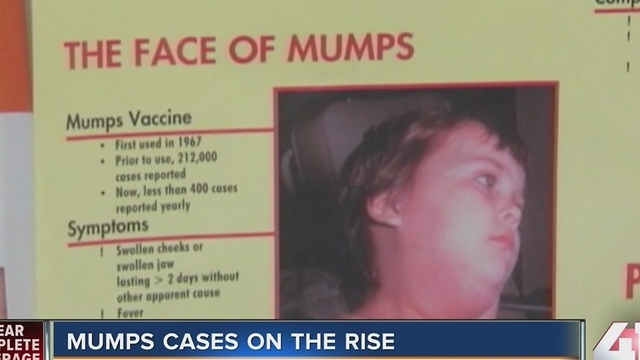 Mumps cases on the rise