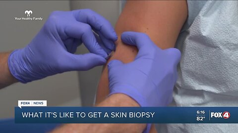 Your Healthy Family: What it's like to get a skin biopsy