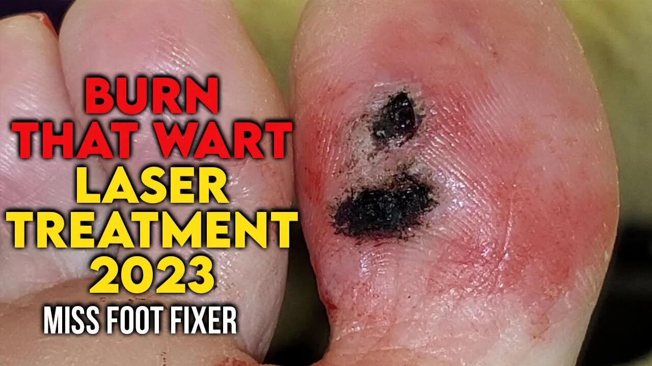 " BURN THAT WART " LASER TREATMENT FOR FOOT WART [2023] BY FOOT SPECIALIST MISS FOOT FIXER