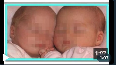 TWIN BABIES killed by VAXX poison: "Simultaneous Sudden Infant Death" case report