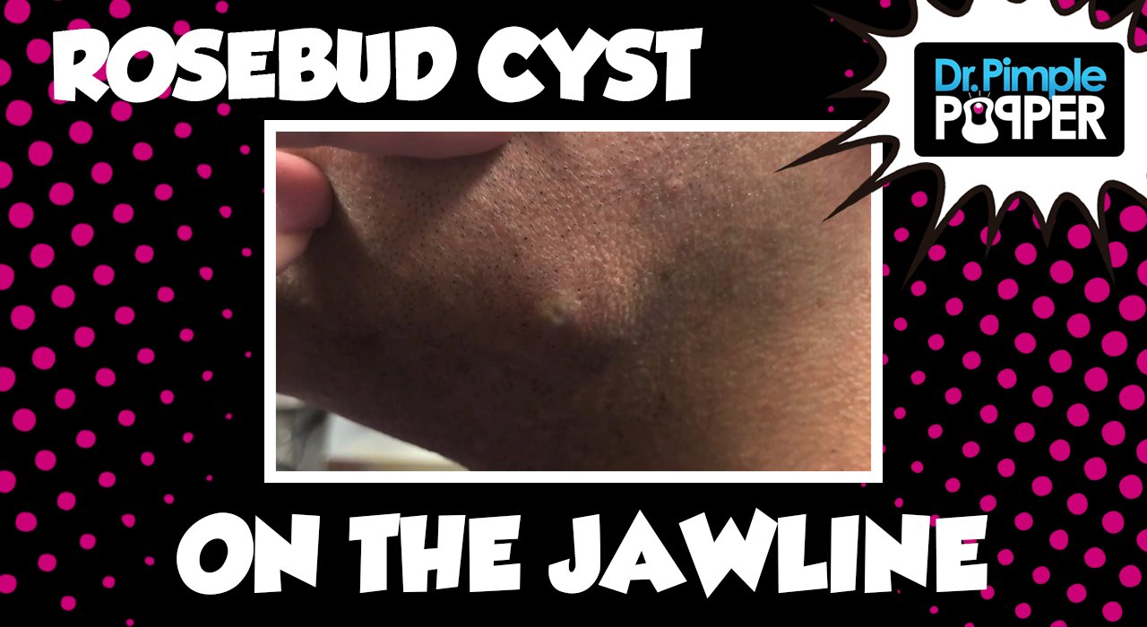 Rosebud Cyst on The Jawline