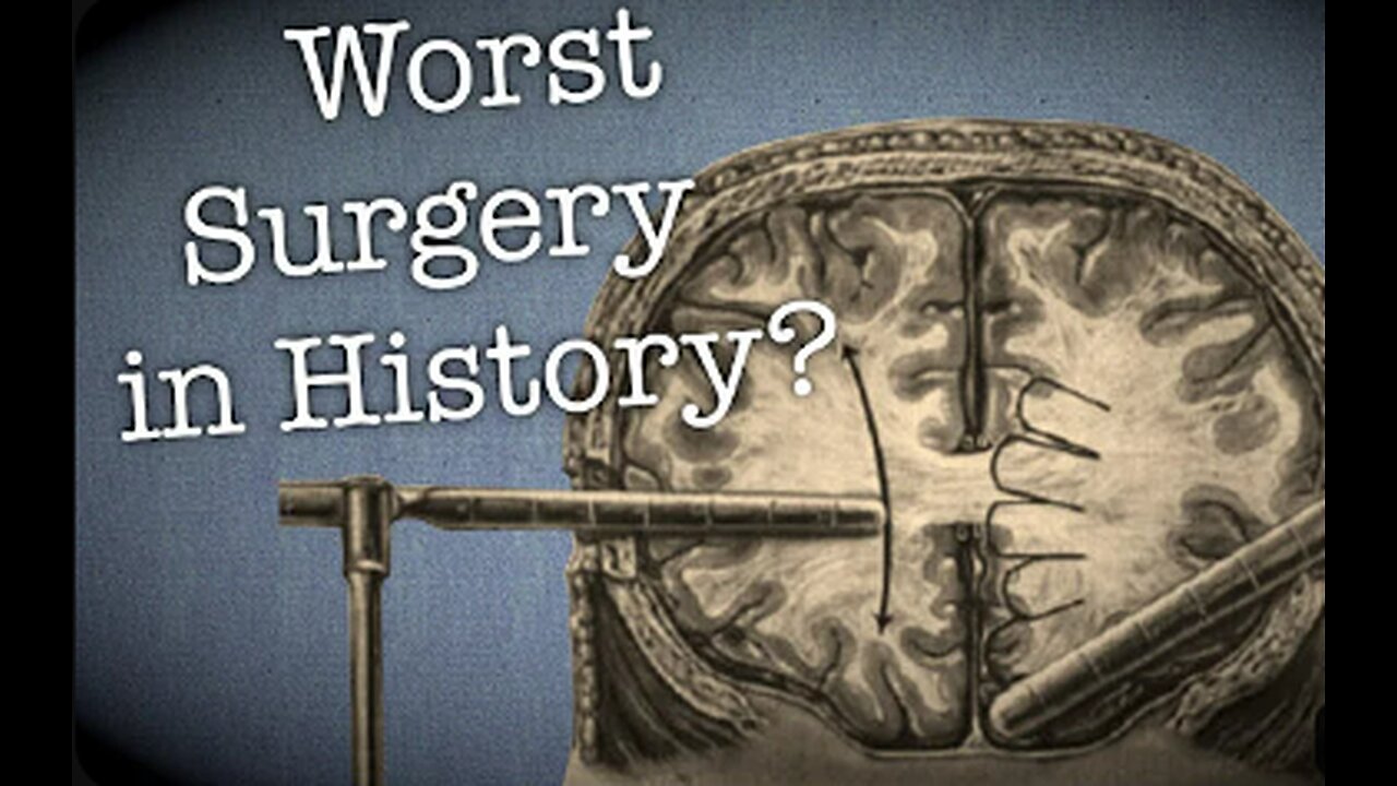 The Dark side of Science: The Lobotomy, the worst surgery in history? (Documentary)