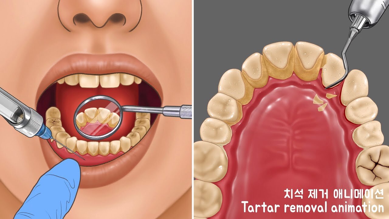 ASMR Very heavy tarter removal animation