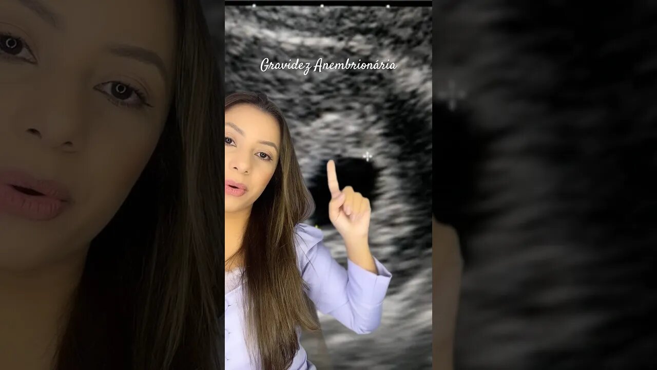 Gravidez Anembrionária