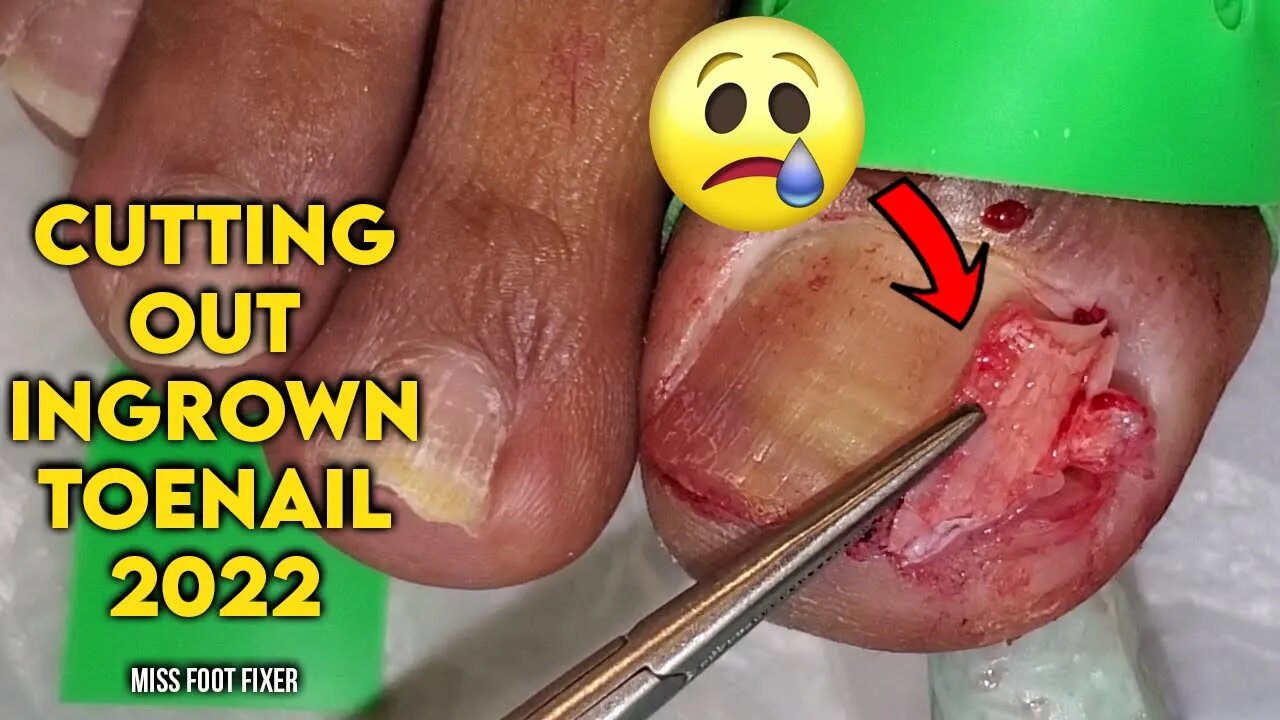 2022 CUTTING OUT DEEP + BLOODY INGROWN TOENAIL BY FOOT SPECIALIST MISS FOOT FIXER