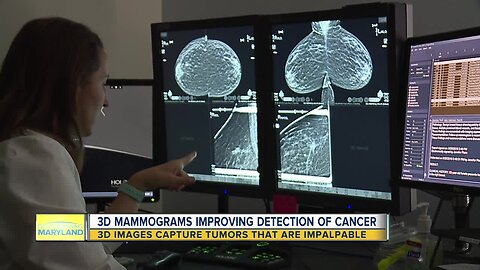 3D Mammograms Improving Detection Of Cancer