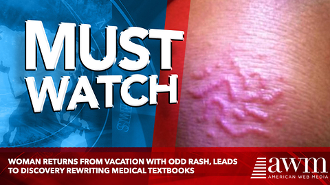 Woman Returns From Vacation With Odd Rash, Leads To Discovery Rewriting Medical Textbooks
