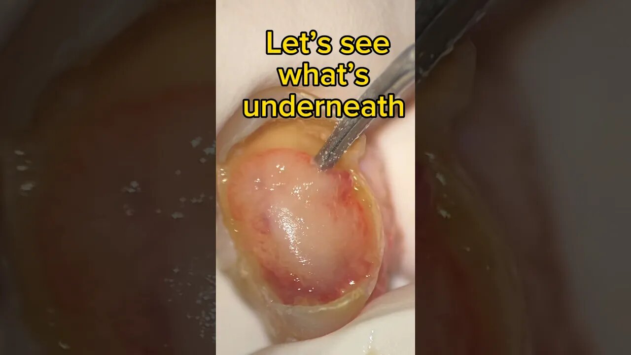 Look what the SURGEON extracted
