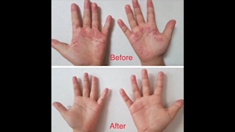 Psoriasis Cured Using The Universal Antidote ClO2