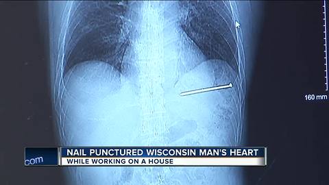 Doctor says nail punctured Wisconsin man's heart