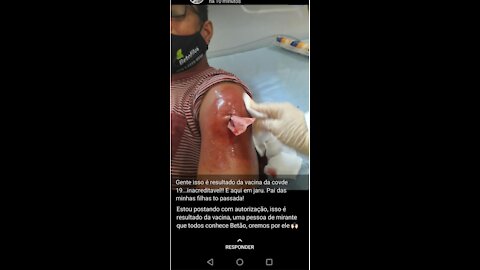 VEJAM A REAÇÃO HORRIVEL Á VACINA