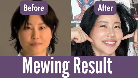 Mewing result before and after