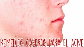 Remedios Caseros Para El Acne