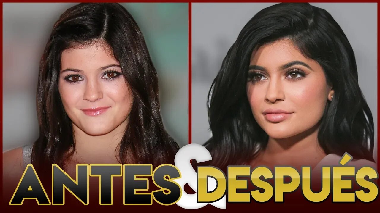 KYLIE JENNER | Transformación Antes y Después | CIRUGÍAS ESTÉTICAS