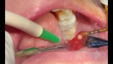 Jawbone surgery showing fat globules and purulent discharge from the jawbone of a patient.