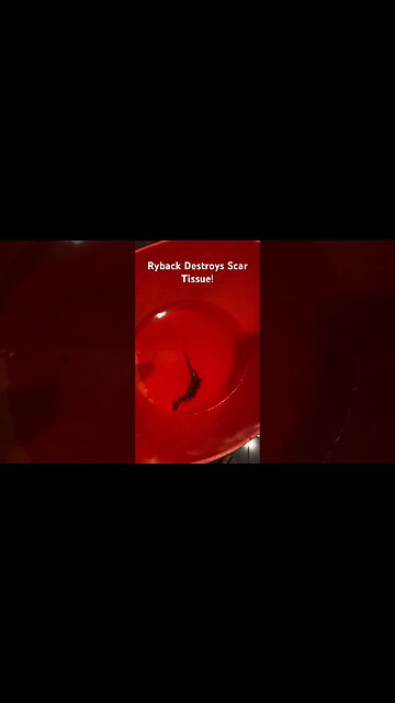 Wet Cupping Vince McMahon Demon Leach Sucked Out Of Shoulder