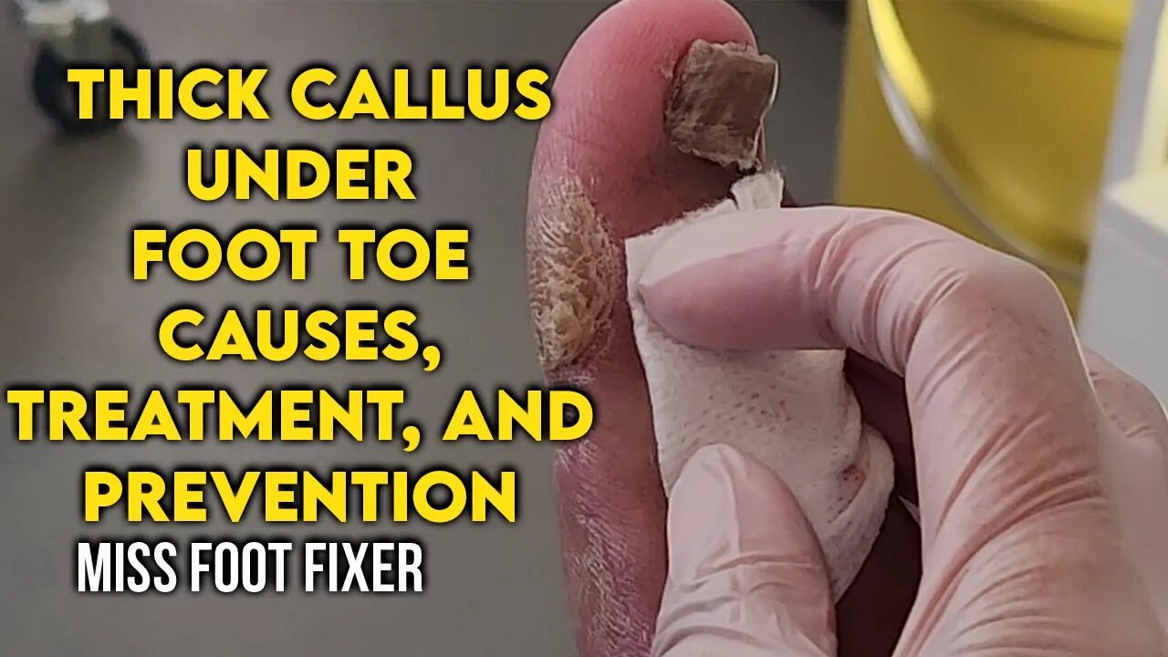 Thick Callus Under Foot Toe: Causes, Treatment, and Prevention By Foot Specialist Miss Foot Fixer