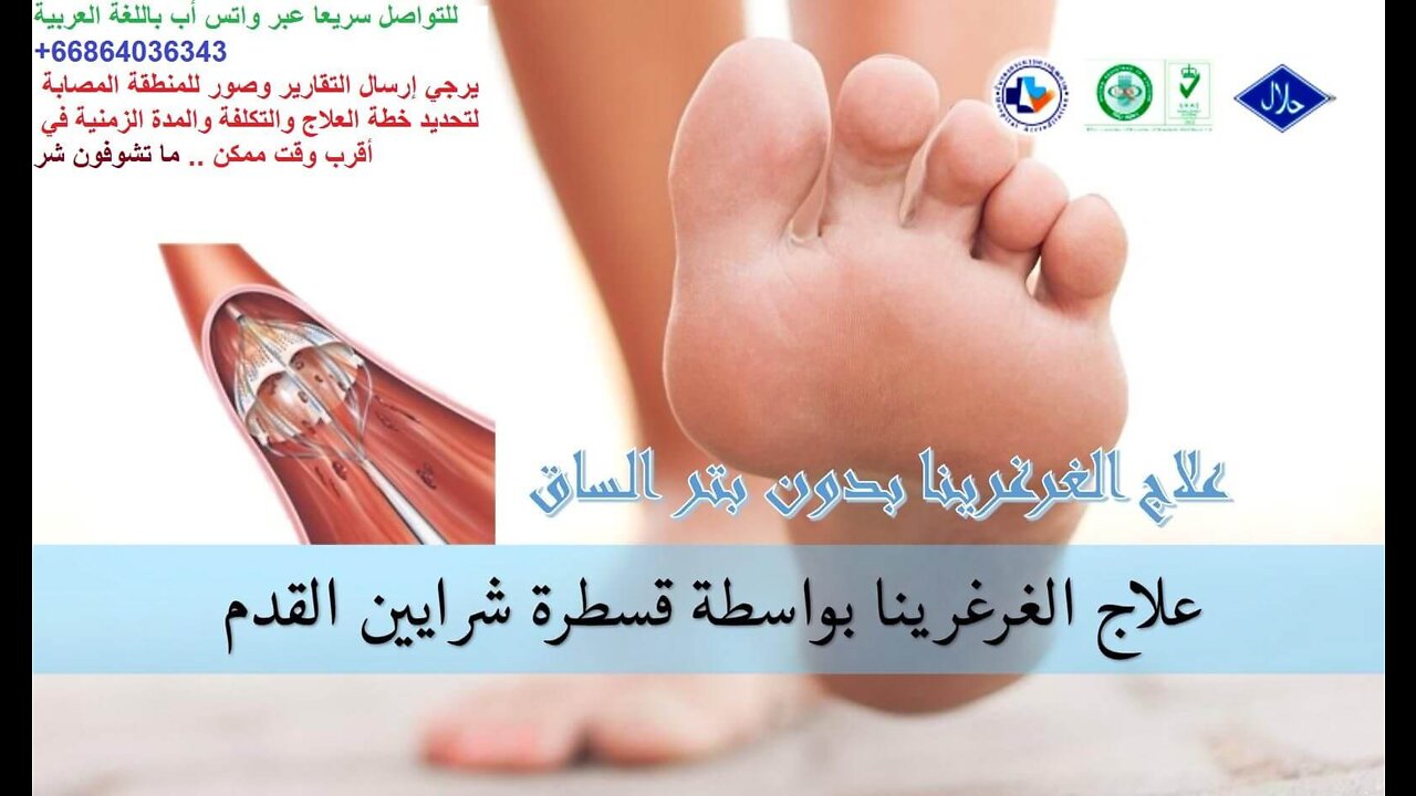 إنطباع مريض الغرغرينا (قرحة القدم السكري) عقب العلاج مع الدكتور بي - واتساب: 0066864036343