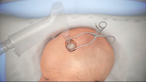 Ventriculostomy brain surgery - 3D animation: