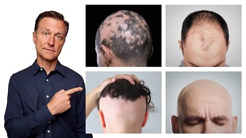 The 11 Types of Alopecia (AND HOW TO FIX IT) - Dr. Berg