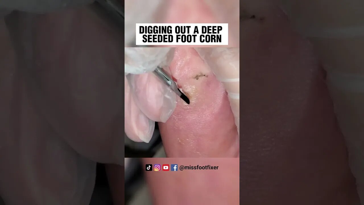 DIGGING OUT A DEEP SEEDED FOOT CORN 2023 | CORN TREATMENT BY FAMOUS PODIATRIST MISS FOOT FIXER