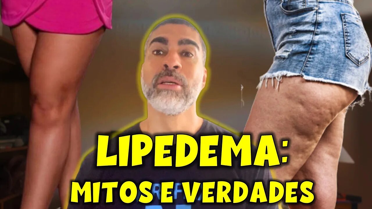 Lipidema: mitos e verdades