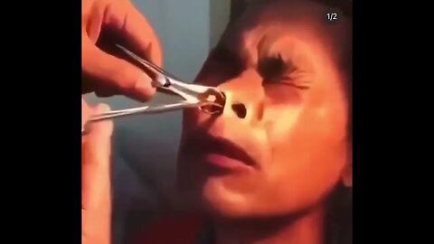 Watch What Comes Out of Chinese Man's Nose