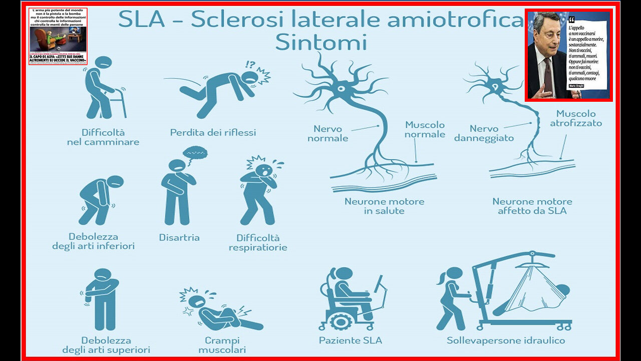 MALATO DI SLA DOPO LA SECONDA 💉💀⚰️DOSE🙉 SLA O SCLEROSI LATERALE AMIOTROFICA: CHI COLPISCE💉SINTOMI⚰️CAUSE💉DIAGNOSI💀⚰️... 🙈​🙉​🙊​...