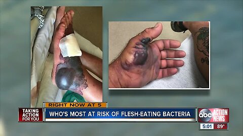 Who are at risk of flesh-eating bacteria