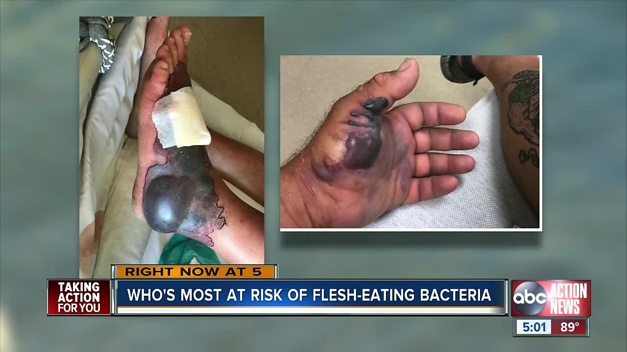 Who are at risk of flesh-eating bacteria