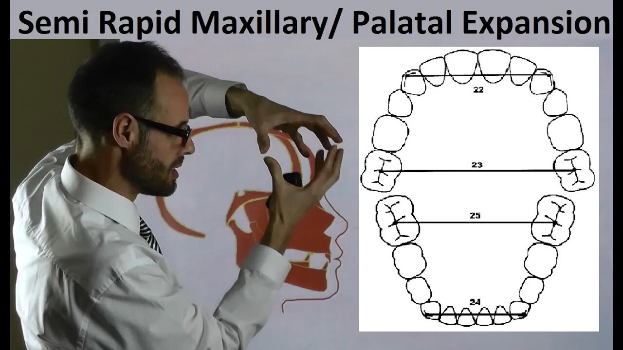 Mechanism of Semi Rapid Palatal, Maxillary Expansion & Teeth Position on Arches by Dr Mike Mew
