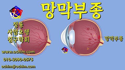 망막부종 원인과 치료 방법 - 사암오행침, 사암침법, 오행침, 정통사암침