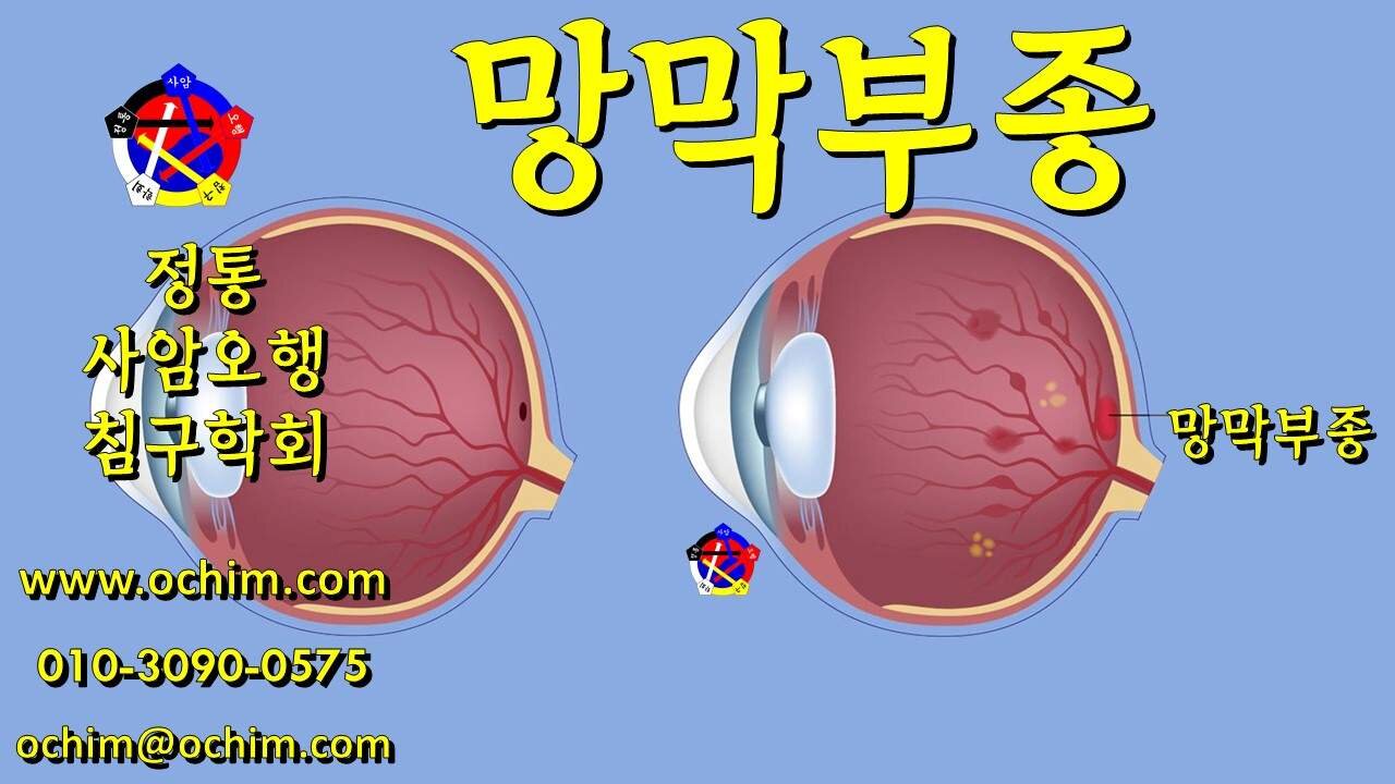 망막부종 원인과 치료 방법 - 사암오행침, 사암침법, 오행침, 정통사암침