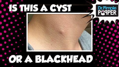 Not a blackhead on his neck: A pilomatricoma!