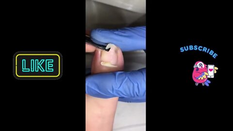 Ingrown Toe Nail Removal #ingrowntoenail #ingrownnail #ingrown #ingrowntoenailremoval