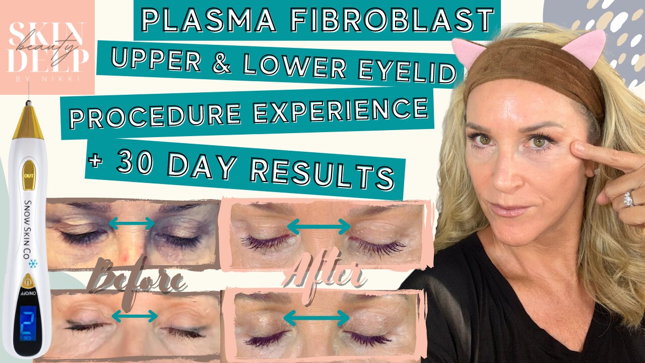 PLASMA FIBROBLAST UPPER & LOWER EYELID PROCEDURE EXPERIENCE + 30 DAY RESULTS