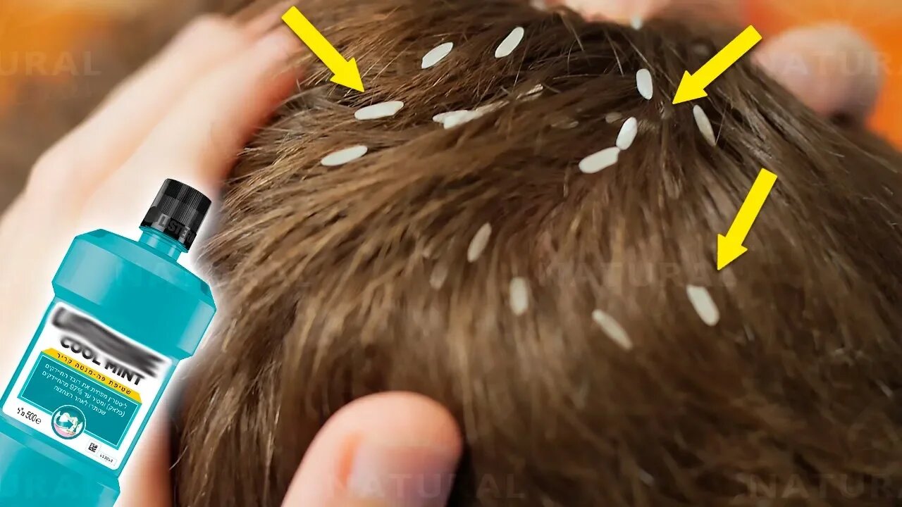 Get Rid of Head Lice With Only One Ingredient