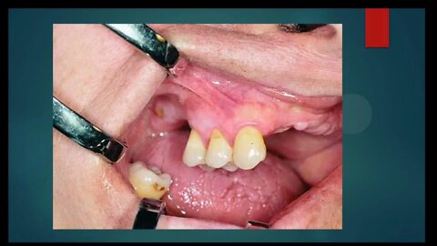 Oral Surgery L1 (Preprosthetic Surgery)