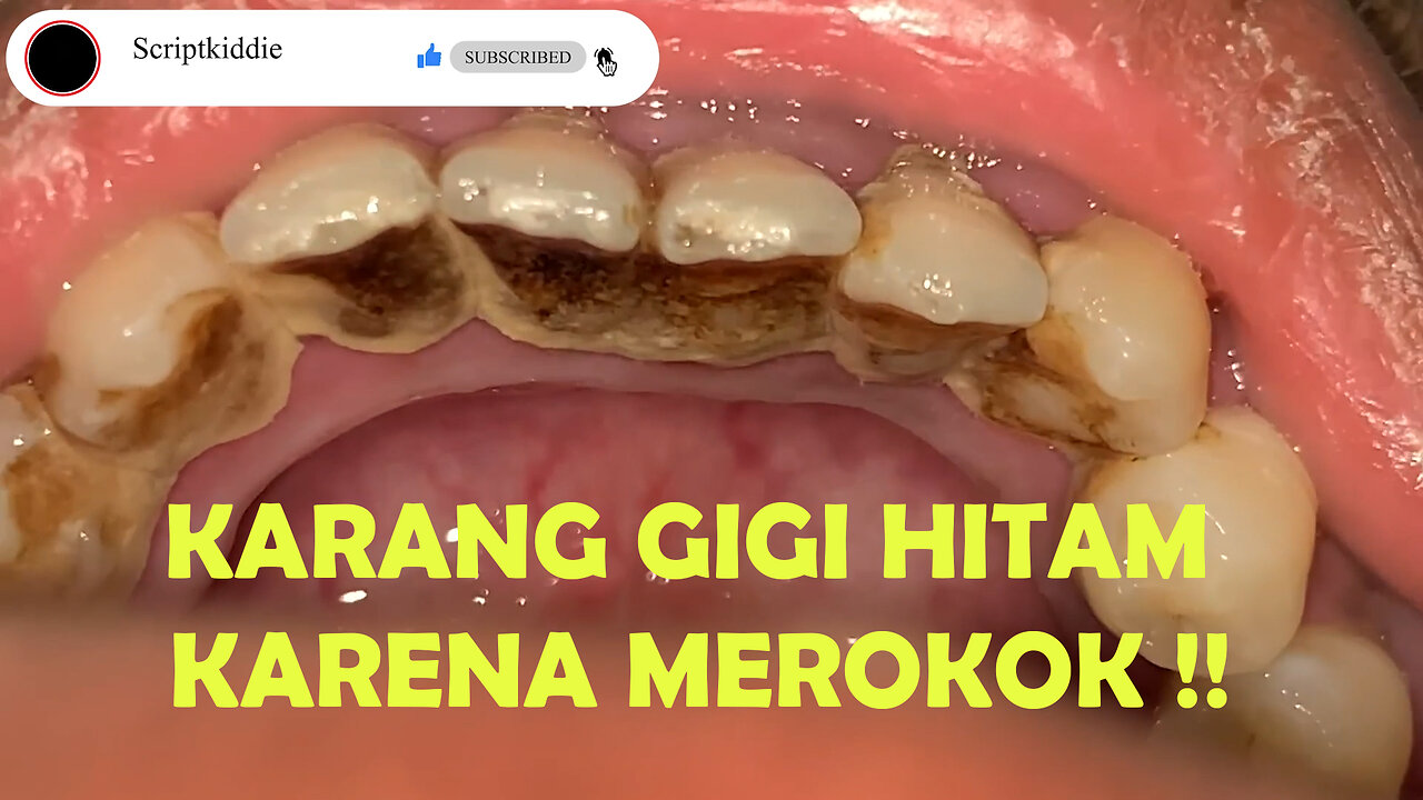 Remove tartar scaling dentist